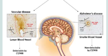 Neuro cognitive disorder - emocare